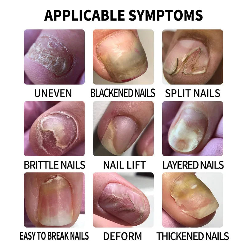 Nail Fungus Treatment Serum – Anti-Infection & Fungal Repair Gel for Toes and Hands