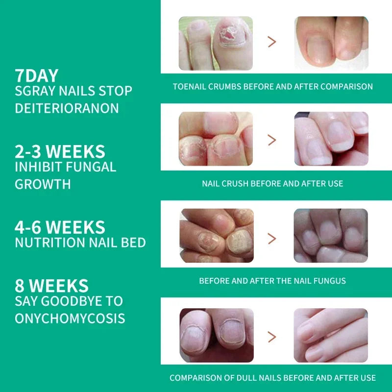 Extra Strong Nail Fungus Treatment Serum – Essence Oil for Toe & Foot Repair