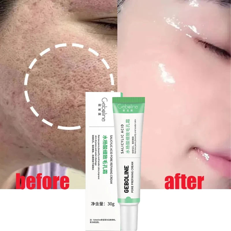 Salicylic Acid Pore Shrinking Cream | Quick Blackhead Removal | Smooths Skin, Tightens Face | Eliminates Large Pores | Korean Skincare Product