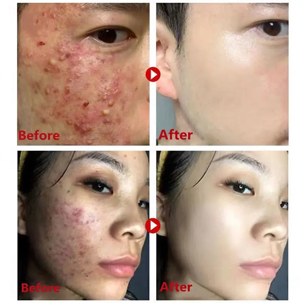 40g Patlıcan ve Yeşil Çay Katı Maske | Siyah Noktaları Temizler, Gözenekleri Küçültürü | Yağ Kontrolü, Yağı Dengeler | Canlandırıcı Temizleyici, Çamur Maskesi