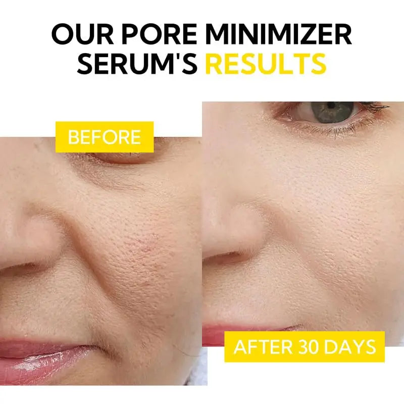 PorePerfect Repair Serum: Salisilik Asit ve Hyaluronik Hidrasyon