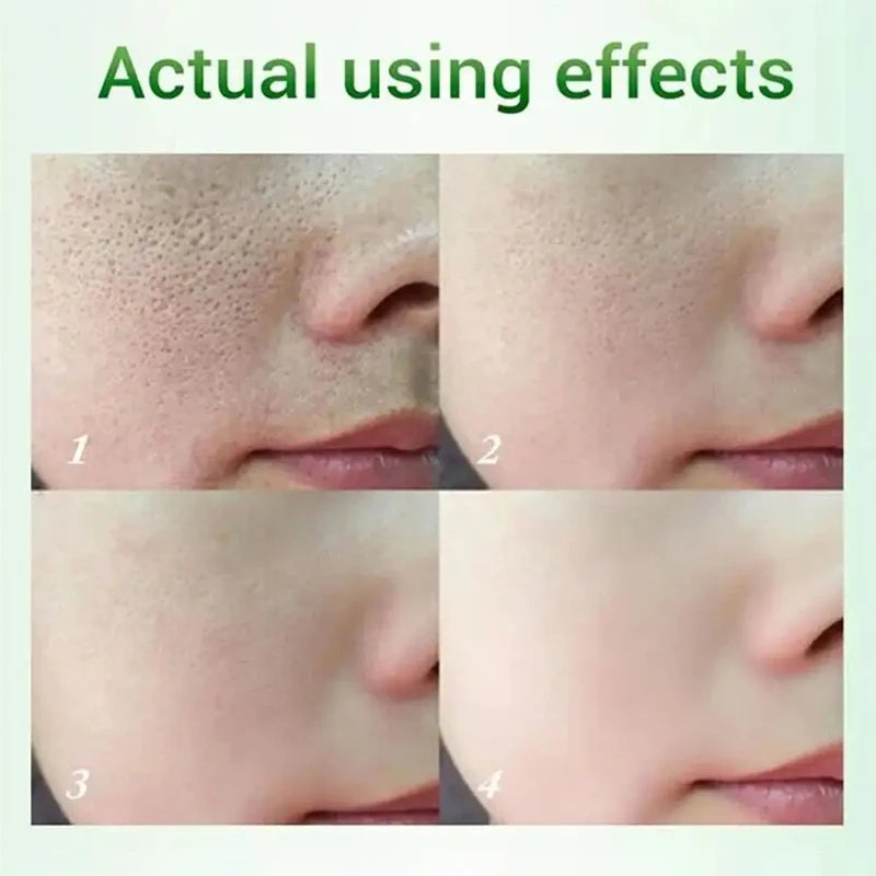 Salicylic Acid Pore Shrinking Cream | Quick Blackhead Removal | Smooths Skin, Tightens Face | Eliminates Large Pores | Korean Skincare Product