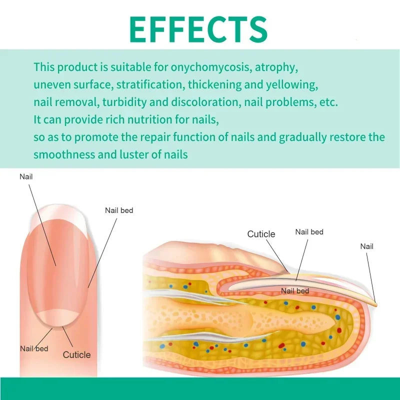 Extra Strong Nail Fungus Treatment Serum – Essence Oil for Toe & Foot Repair