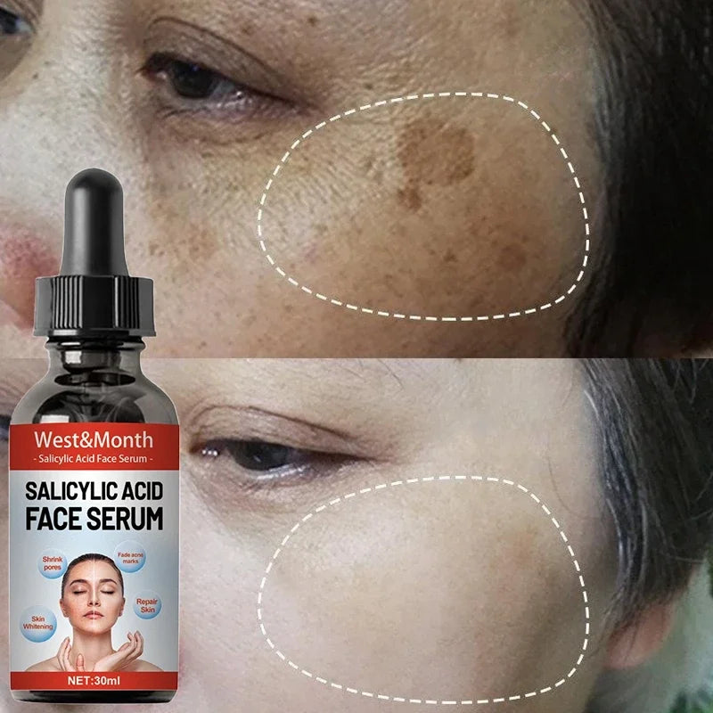 30ml Salisilik Asit Yüz Serumu – Çil ve Koyu Leke Giderici, Gözenek Küçültücü ve Beyazlatıcı Niacinamid Cilt Bakımı