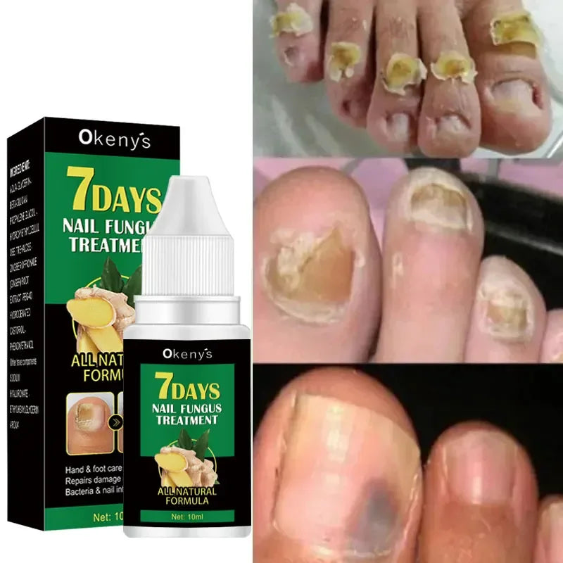 Extra Strong Nail Fungus Treatment Serum – Essence Oil for Toe & Foot Repair