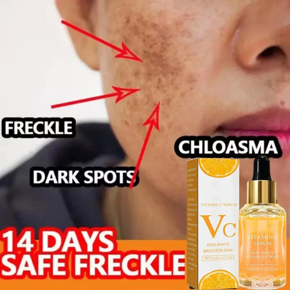 C Vitamini ve Retinol Koyu Leke Giderici Serum – Beyazlatıcı ve Çil Soldurucu Kırışıklık Karşıtı Öz