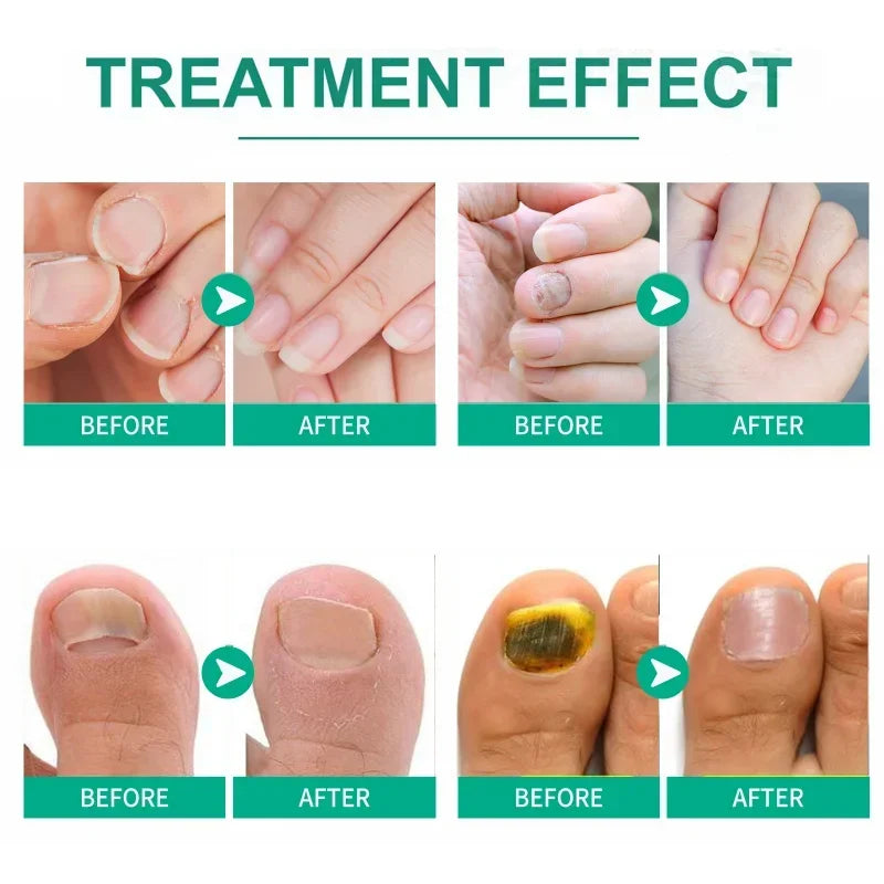 Extra Strong Nail Fungus Treatment Serum – Essence Oil for Toe & Foot Repair