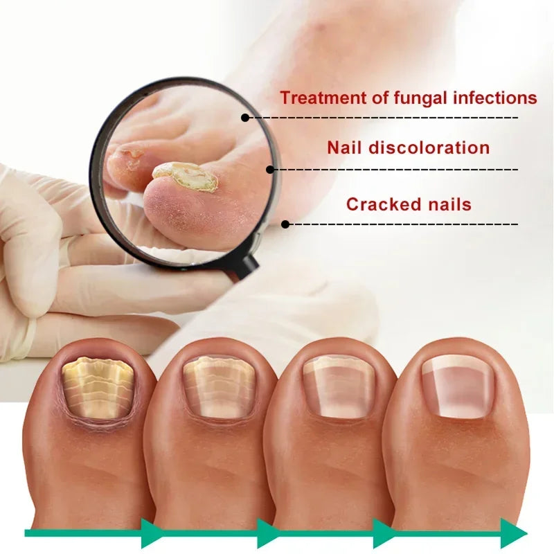Extra Strong Nail Fungus Treatment Serum – Essence Oil for Toe & Foot Repair