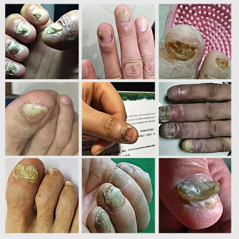 Extra Strong Nail Fungus Treatment Serum – Essence Oil for Toe & Foot Repair