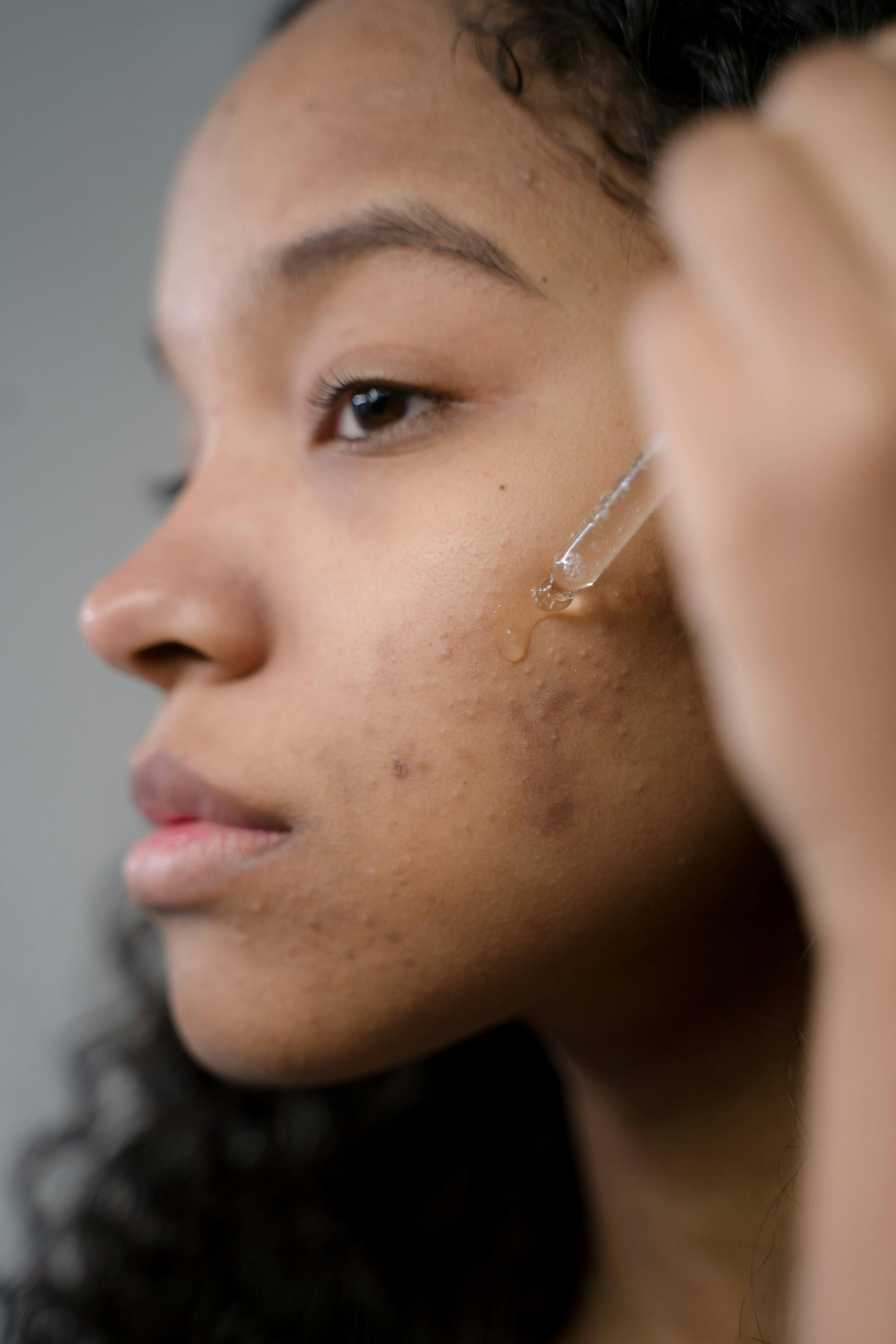 BlemishBarrier Acne Treatment