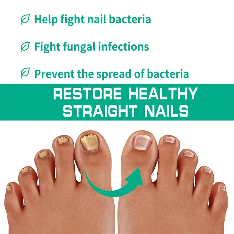 Nail Fungus Treatment Serum – Anti-Infection &amp; Fungal Repair Gel for Toes and Hands