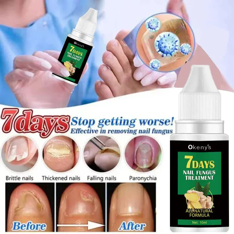 Extra Strong Nail Fungus Treatment Serum – Essence Oil for Toe &amp; Foot Repair
