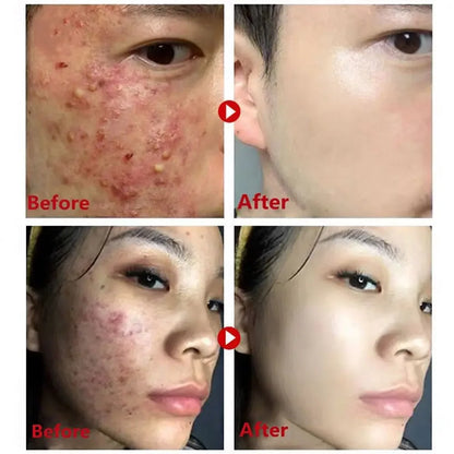 40g Patlıcan ve Yeşil Çay Katı Maske | Siyah Noktaları Temizler, Gözenekleri Küçültürü | Yağ Kontrolü, Yağı Dengeler | Canlandırıcı Temizleyici, Çamur Maskesi