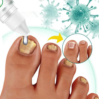 Nail Fungus Treatment Serum – Anti-Infection &amp; Fungal Repair Gel for Toes and Hands