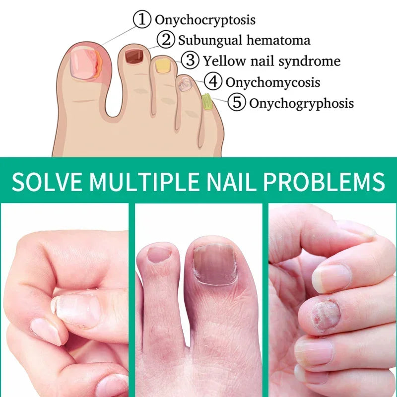 Extra Strong Nail Fungus Treatment Serum – Essence Oil for Toe &amp; Foot Repair