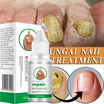 Nail Fungus Treatment Serum – Anti-Infection &amp; Fungal Repair Gel for Toes and Hands