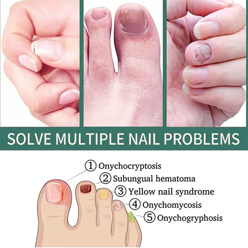 Nail Fungus Treatment Serum – Anti-Infection &amp; Fungal Repair Gel for Toes and Hands
