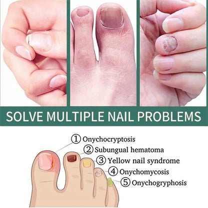 Nail Fungus Treatment Serum – Anti-Infection &amp; Fungal Repair Gel for Toes and Hands