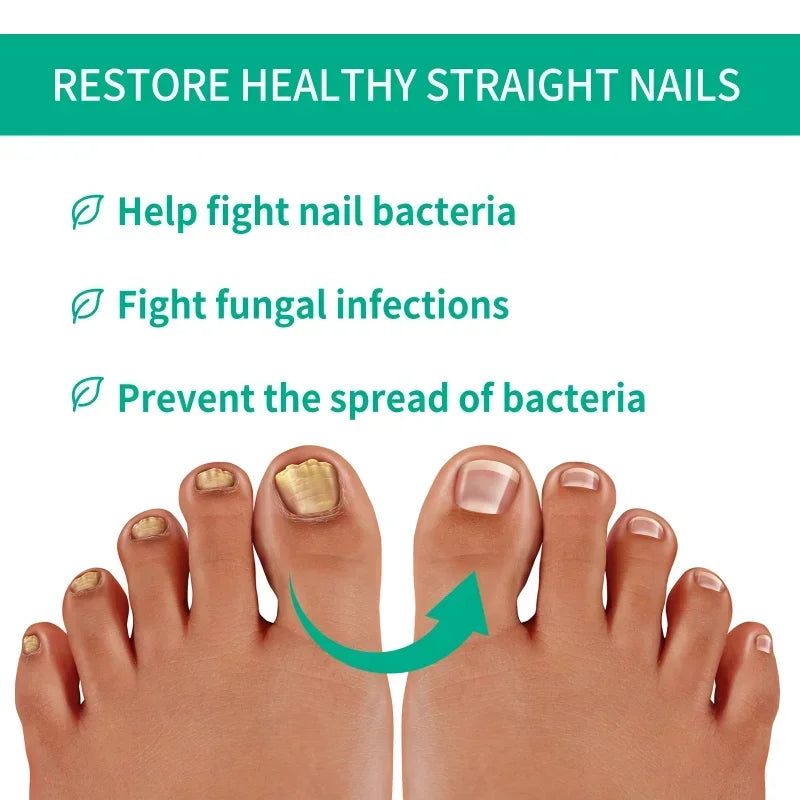 Extra Strong Nail Fungus Treatment Serum – Essence Oil for Toe &amp; Foot Repair