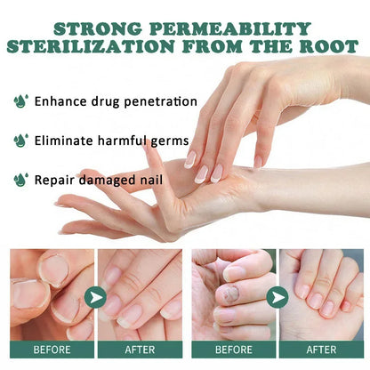 Nail Fungus Treatment Serum – Anti-Infection &amp; Fungal Repair Gel for Toes and Hands