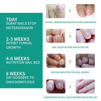 Nail Fungus Treatment Serum – Anti-Infection &amp; Fungal Repair Gel for Toes and Hands