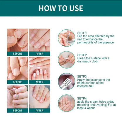 Nail Fungus Treatment Serum – Anti-Infection &amp; Fungal Repair Gel for Toes and Hands