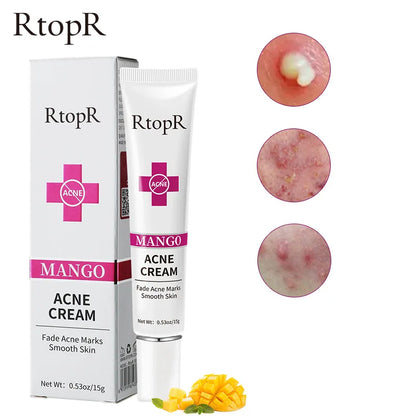 RtopR Mango Anti-Acne Facial Gel – Pimple Remover &amp; Pore Shrinker